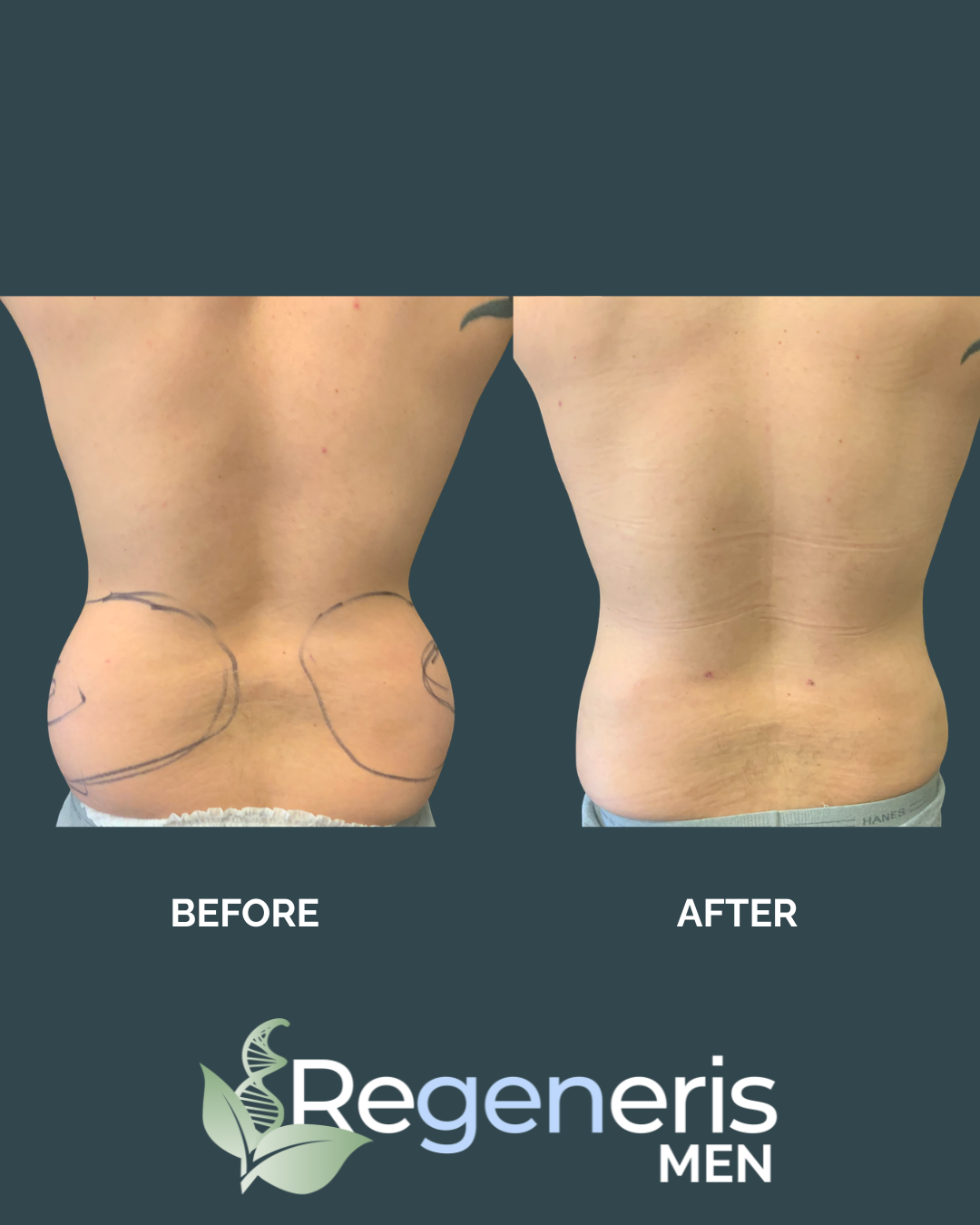 liposuction-case-1-5