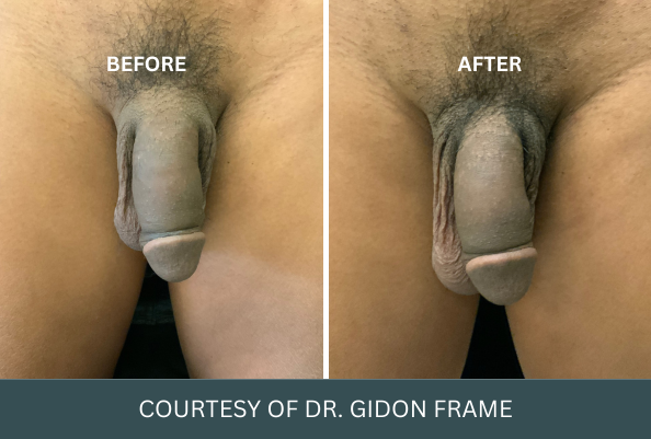 penis-enlargement-case-10