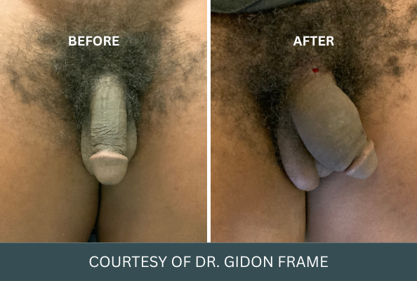 penis-enlargement-case-11