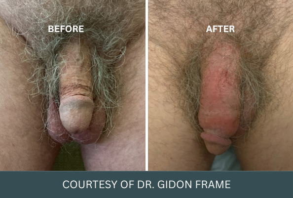 penis-enlargement-case-13