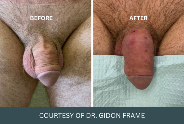 penis-enlargement-case-14