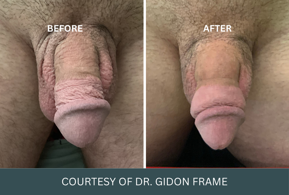penis-enlargement-case-17