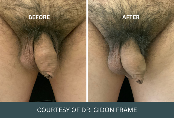 penis-enlargement-case-7