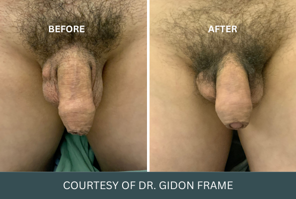 penis-enlargement-case-9