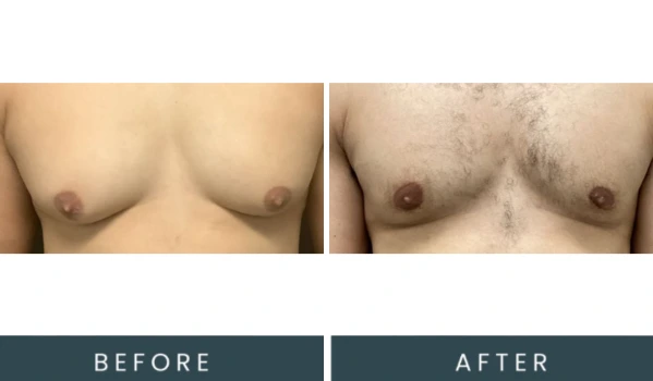 Before and after front view chest comparison labeled