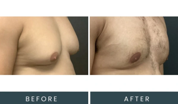 Before and after left angle chest comparison labeled