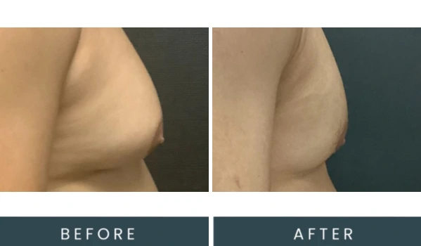 Case 38 before and after left side view comparison