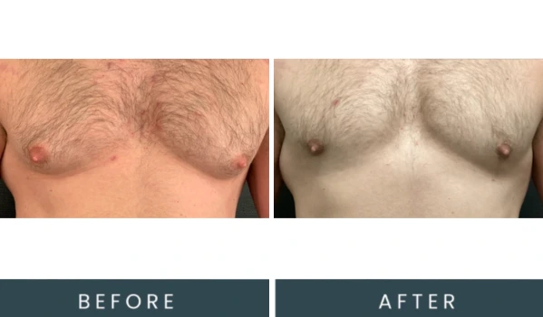Case 39 before and after front view comparison