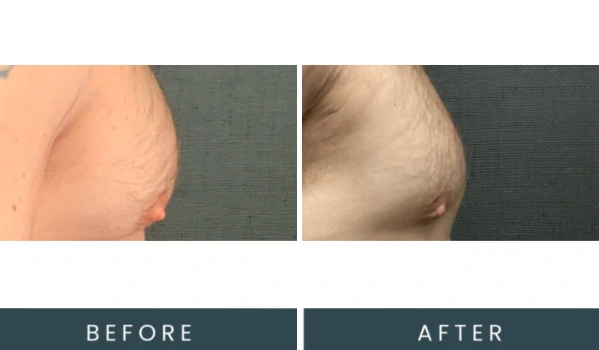 Case 39 before and after left side view comparison