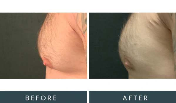 Case 39 before and after right side view comparison