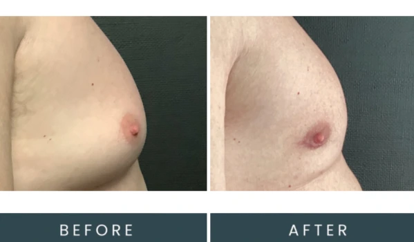 Before and after chest contouring side view comparison