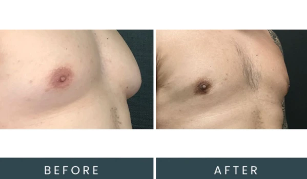 Before and after chest contouring angled view comparison