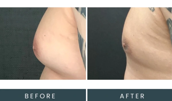 Case 41 right side view before and after chest procedure