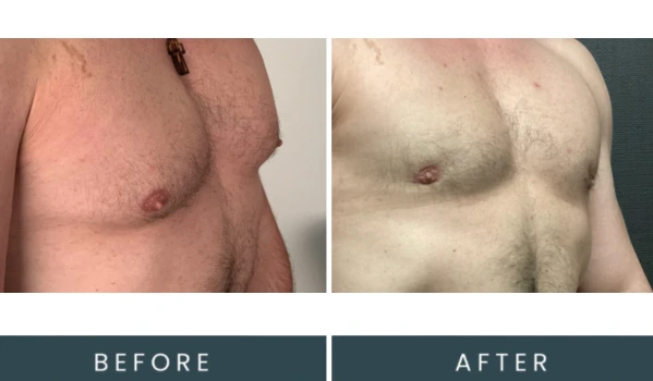 Case 42 angled view before and after chest procedure