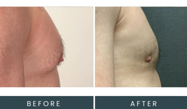Case 42 left side view before and after chest procedure