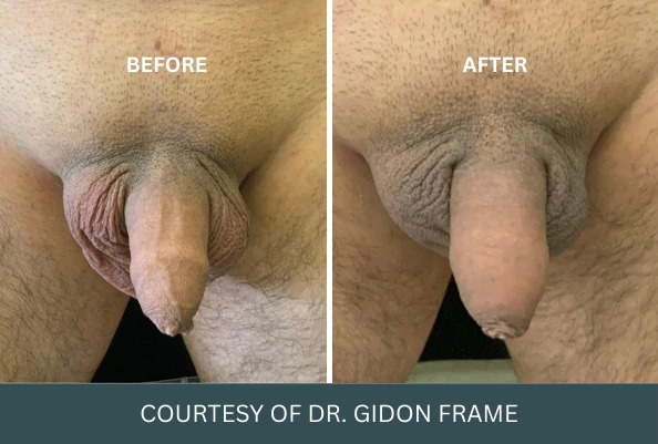 Before and after penile enhancement results courtesy of Dr. Gidon Frame