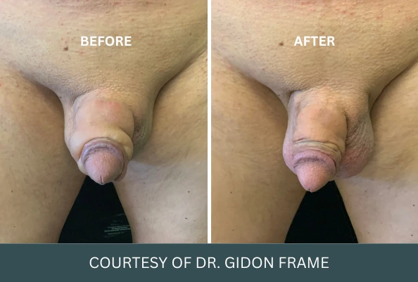 Before and after penile enhancement results courtesy of Dr. Gidon Frame