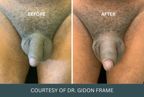 Before and after penile enhancement results, courtesy of Dr. Gidon Frame