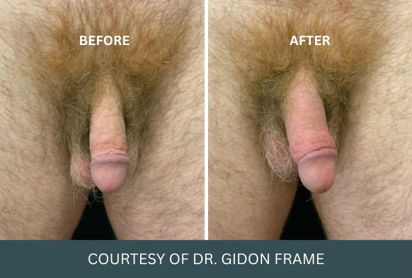 Before and after penile enhancement results courtesy of Dr. Gidon Frame