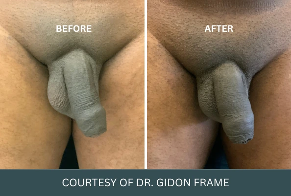 Before and after penile enhancement results courtesy of Dr. Gidon Frame