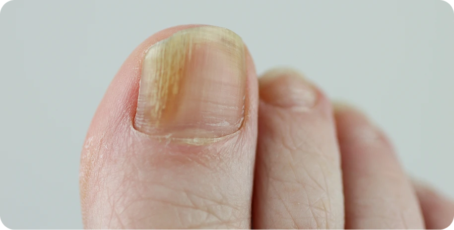 Toenail with lifting and peeling edges, showing discoloration and separation from nail bed