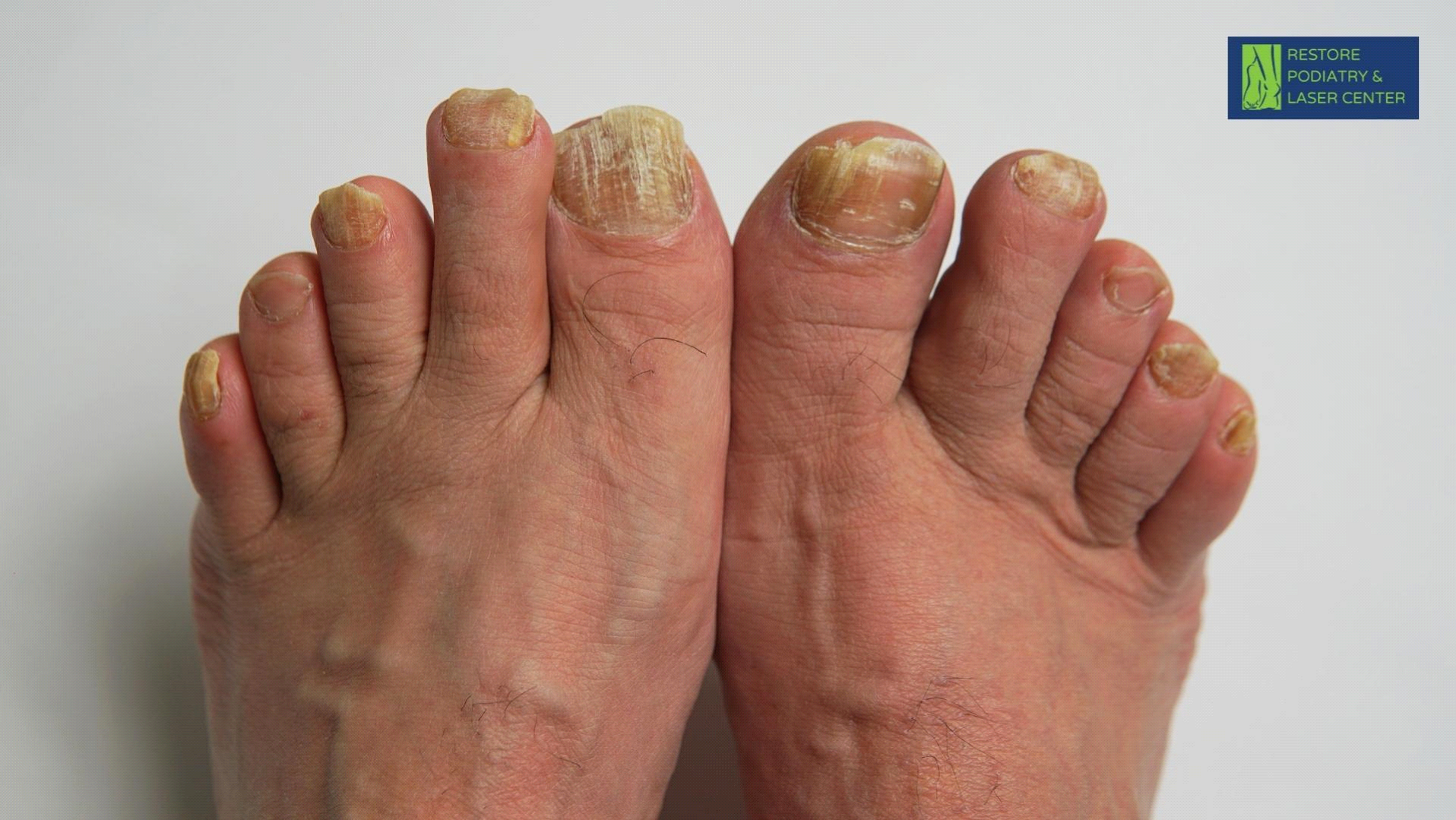 toenail-fungus-vs-damage-how-to-spot-the-difference-restore-podiatry