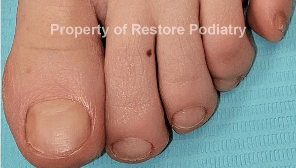 Toenail fungus Case 3 after — 3 years