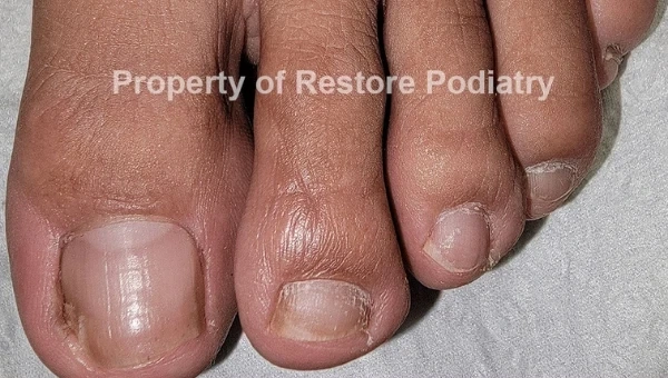 Toenail fungus Case 5 after — 6 years