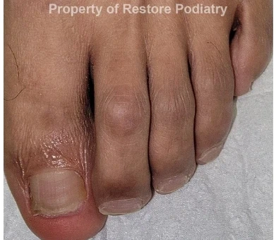 Toenail fungus Case 9 after — 5 years