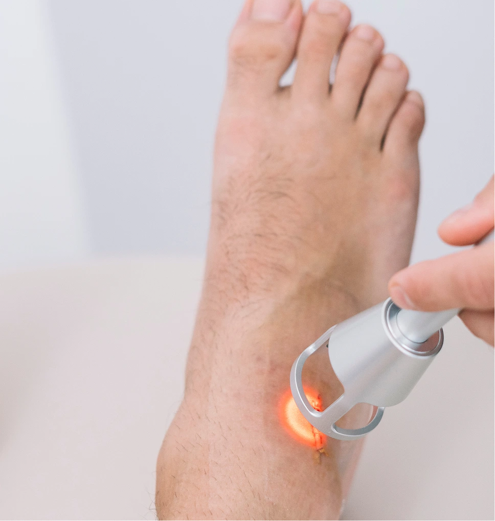 Laser device being applied to a patient's foot during treatment