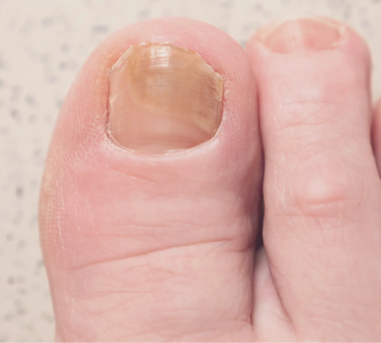 Causes and Symptoms of Ingrown Toenails Banner