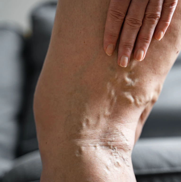Varicose Veins Treatment Miami, FL Banner