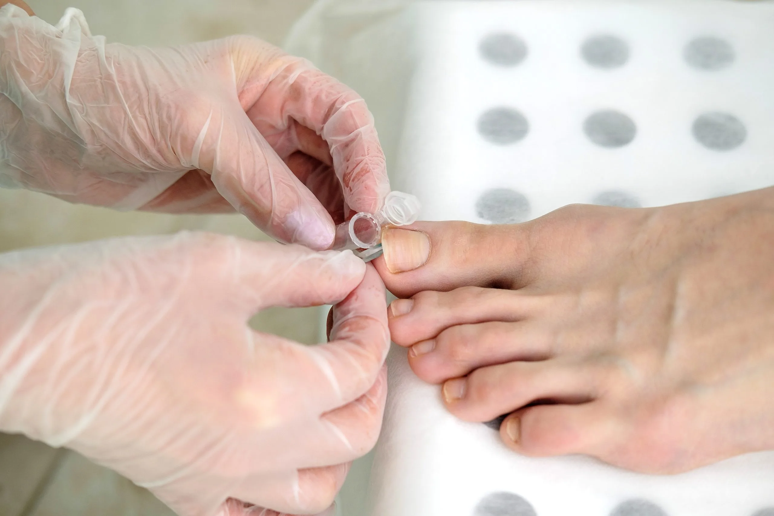 Gloved healthcare provider applying treatment to a patient's hand during a medical procedure
