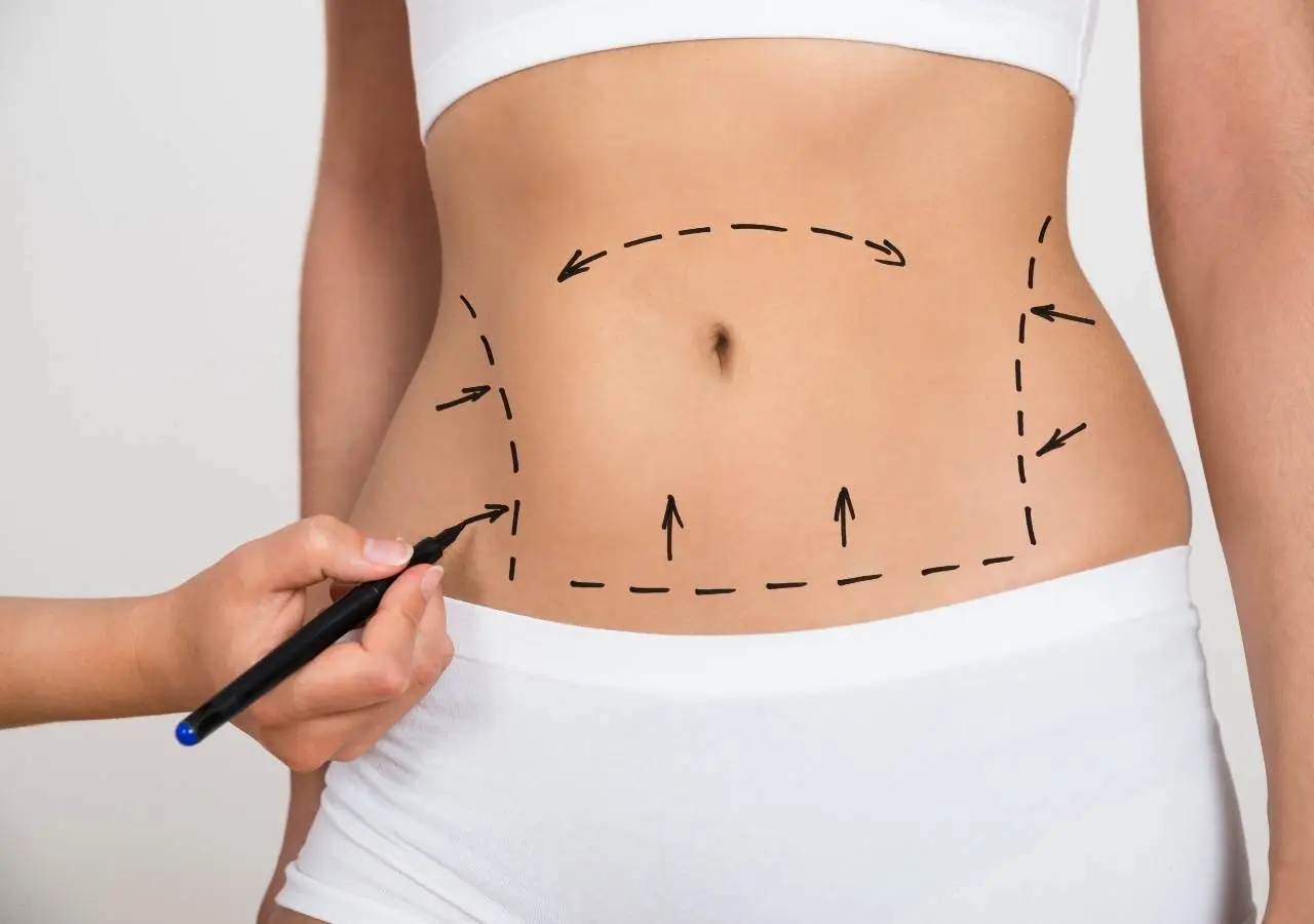 Liposuction and J-Plasma
