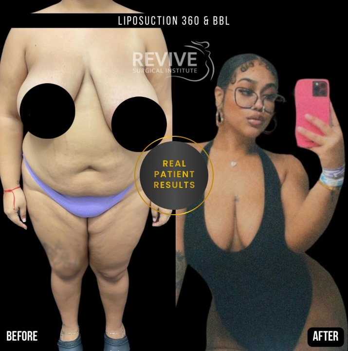 Plus-Size Liposuction procedure