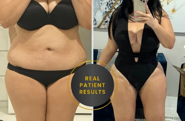 Preparation for High-BMI Liposuction