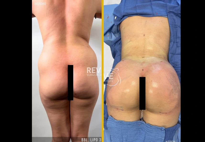 BBL lipo 360 jplasma