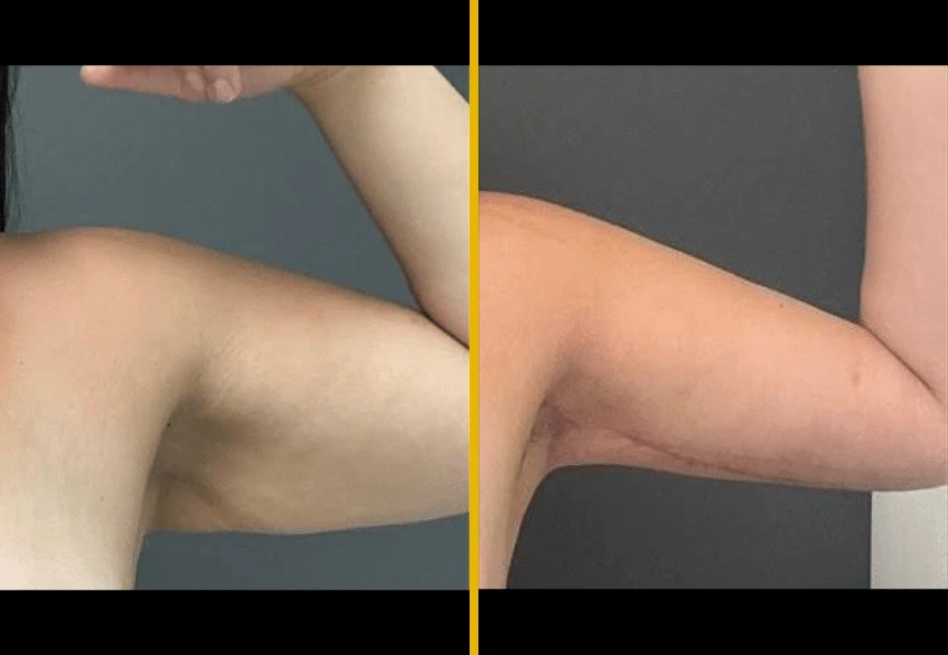 Brachioplasty-1