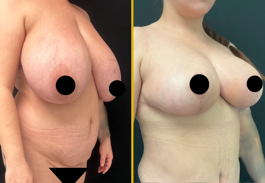 Breast-Reduction-1.1