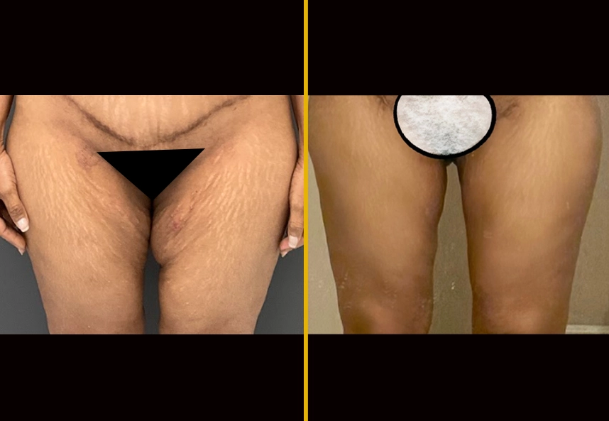 Before and After Gallery: Skin Tightening