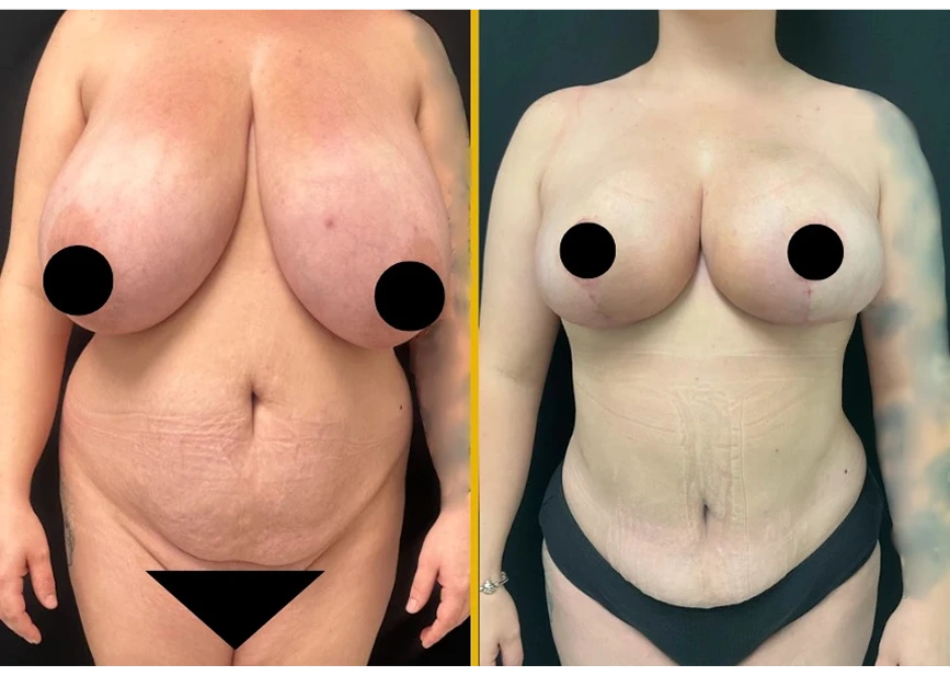 What Is a Breast Reduction Procedure? Banner