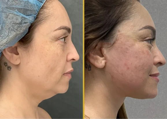 What Is a Neck Lift? Banner