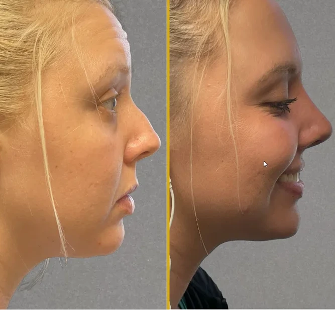 What Is Rhinoplasty? Banner