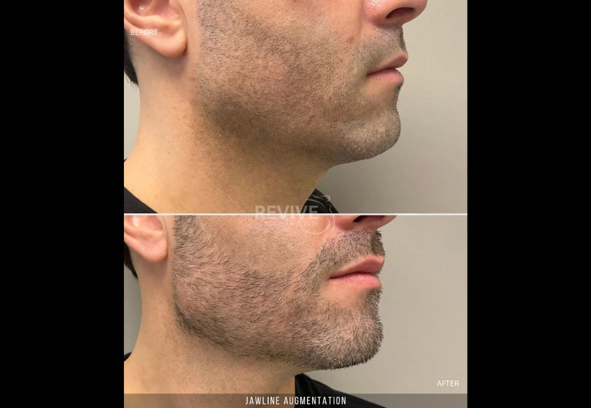Jawline Augmentation
