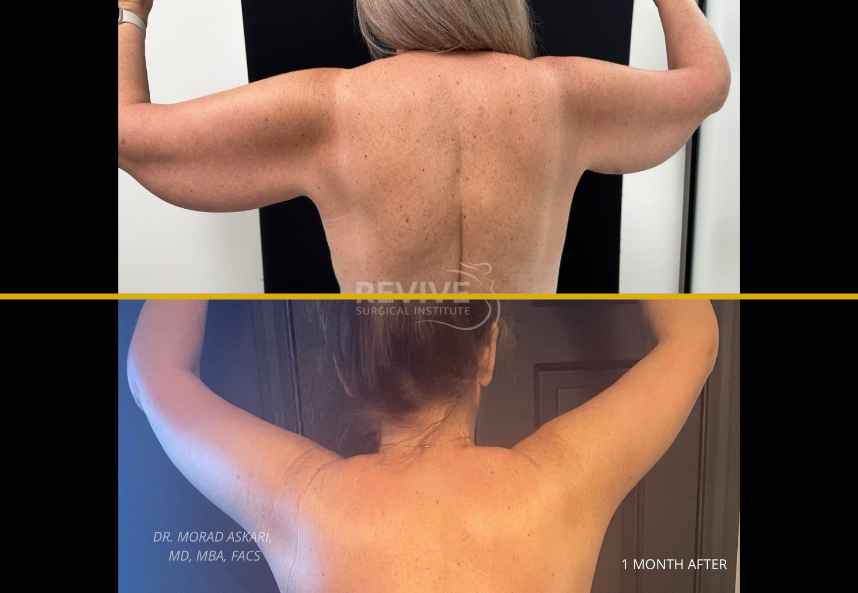 Before and after brachioplasty showing arm lift results at one month, patient with arms raised displaying reduced loose skin