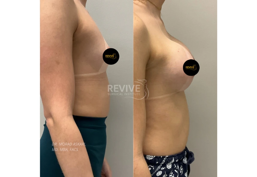 Breast Augmentation (4)