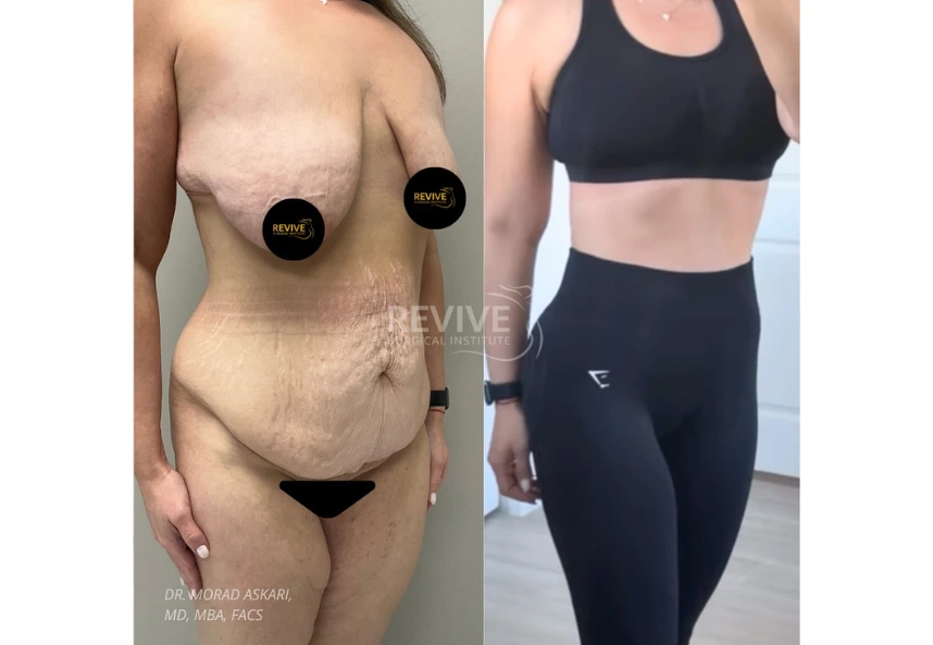 Revive Xlift case 80-2