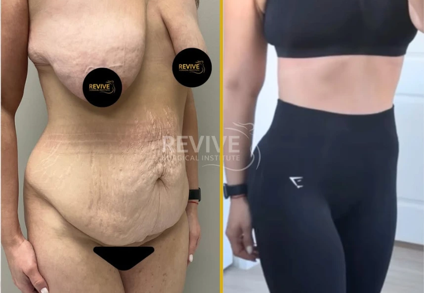 Before and After Gallery: Tummy Tuck