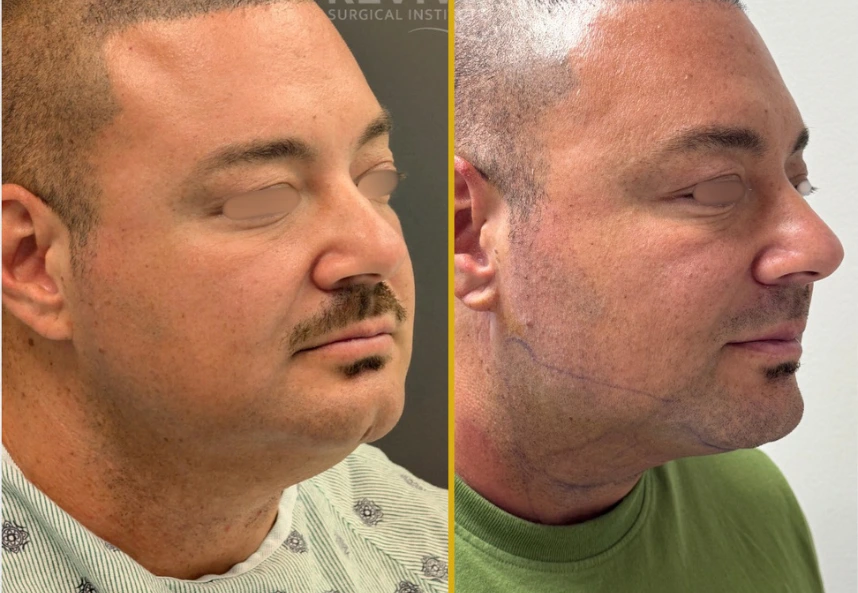 Facial Fat Transfer (4)