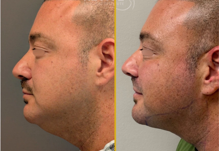 Facial Fat Transfer (5)